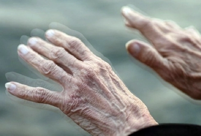 Liên tục run khi nghỉ là triệu chứng chính của bệnh Parkinson, làm ảnh hưởng nhiều đến khả năng vận động của người bệnh. Ảnh: Medere