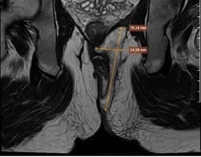 Hình chụp MRI cho thấy đường rò (mũi tên vàng) ăn luồng phức tạp. Ảnh: Bệnh viện Đa khoa Tâm Anh