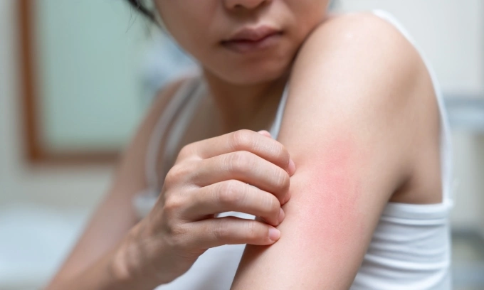 Người hay bị muỗi đốt nên ưu tiên tiêm vaccine ngừa sốt xuất huyết, viêm não Nhật Bản và tiêm vaccine ngừa sốt vàng nếu đi đến vùng dịch. Ảnh minh họa: Vecteezy