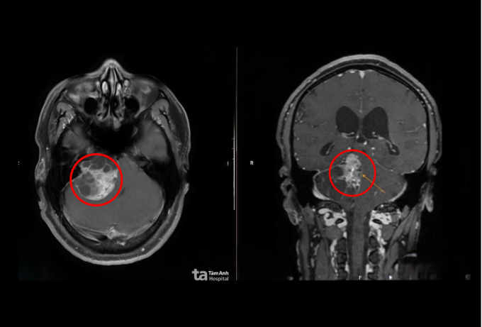 Chụp MRI 1.5 Tesla cho thấy khối u chèn ép thân não anh Khôi. Ảnh: Bệnh viện Đa khoa Tâm Anh