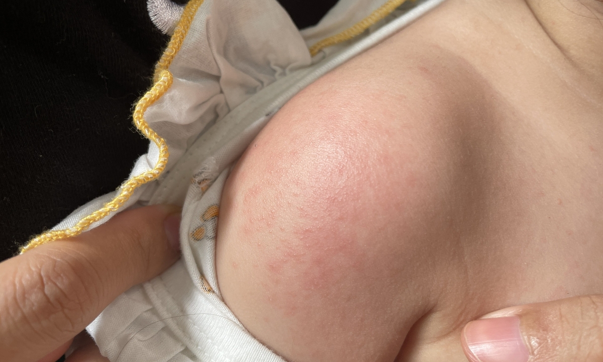 Bệnh Chikungunya ảnh hưởng đến trẻ thế nào?