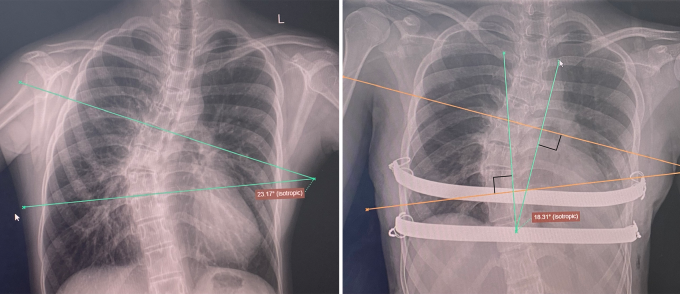 Ảnh X-quang trước mổ (trái) cho thấy vẹo cột sống ngực, góc Cobb 22,5 độ và ảnh X-quang sau mổ (phải) ghi nhận thanh nâng đúng vị trí, vẹo cột sống có cải thiện góc Cobb 18 độ. Ảnh: Bệnh viện cung cấp