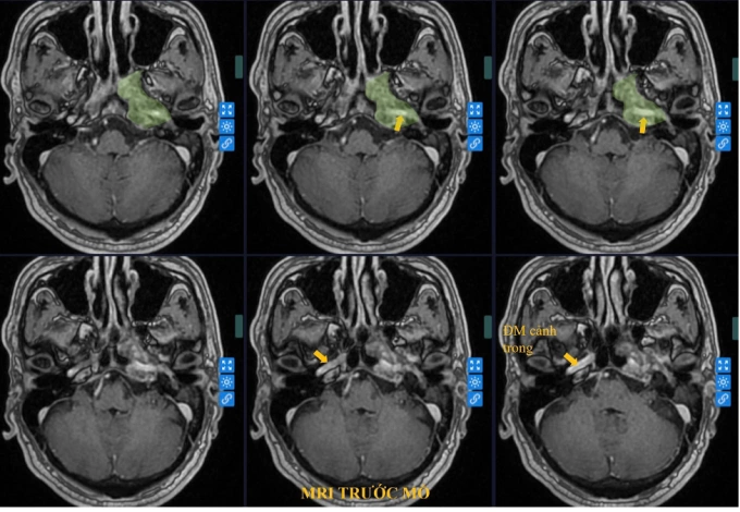 Ảnh chụp MRI khối u nằm sâu trong vùng xương đá. Ảnh: Bệnh viện Đa khoa Tâm Anh