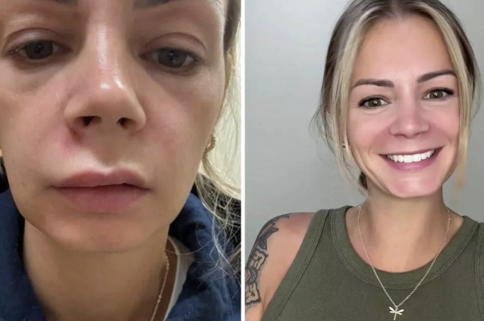 Alisha Monaco không hề biết rằng việc nặn một nốt mụn đơn giản lại có thể nguy hiểm đến vậy. Ảnh: Jam Press