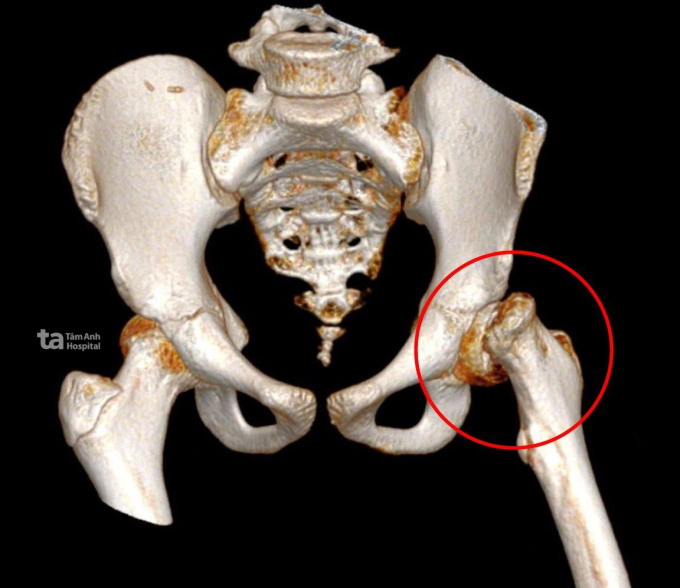 Kết quả CT Scan dựng hình 3D cho thấy chỏm xương đùi của Chenda gần trượt hẳn ra ngoài. Ảnh: Bệnh viện Đa khoa Tâm Anh