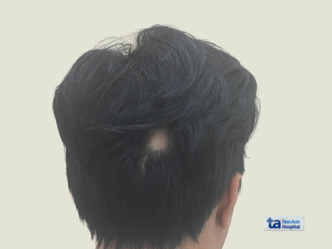 Vùng hói đầu của Nam nhìn từ phía sau. Ảnh: Bệnh viện Đa khoa Tâm Anh