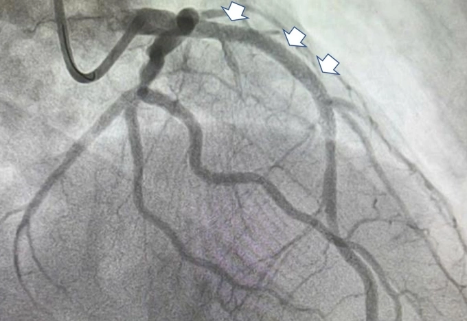 Hình ảnh động mạch liên thất trước của anh Hào sau khi được đặt stent tái thông dòng máu nuôi tim. Ảnh: Bệnh viện cung cấp