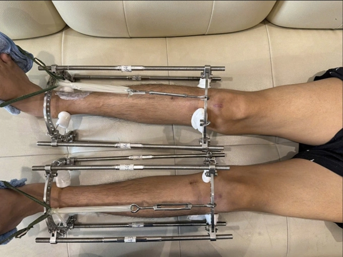 Đôi chân một bệnh nhân sau phẫu thuật lắp khung định hình. Ảnh: Minh Hiếu