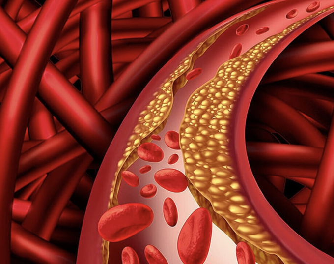 Minh họa cholesterol tích tụ trong máu. Ảnh: My Health My Life