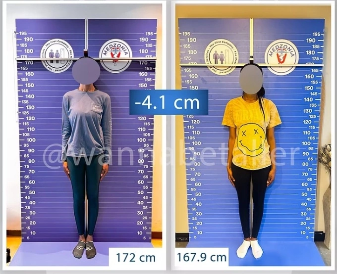 Một bệnh nhân thu ngắn 4,1 cm chân sau phẫu thuật tại Height Reduction. Ảnh: Height Reduction