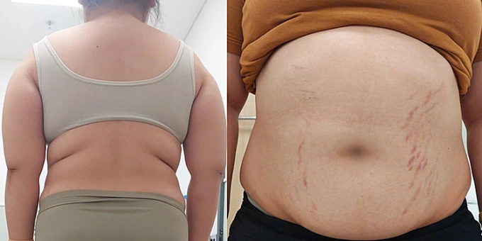 Bệnh nhi tăng 20 kg, vai thô, ụ mỡ gáy, vùng da bụng và đùi rạn đỏ. Ảnh: Bệnh viện cung cấp