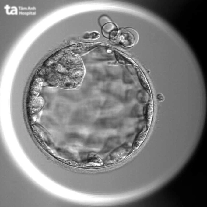 Hình ảnh phôi ngày 5 được nuôi cấy tại IVF Tâm Anh. Ảnh: Thu Thảo