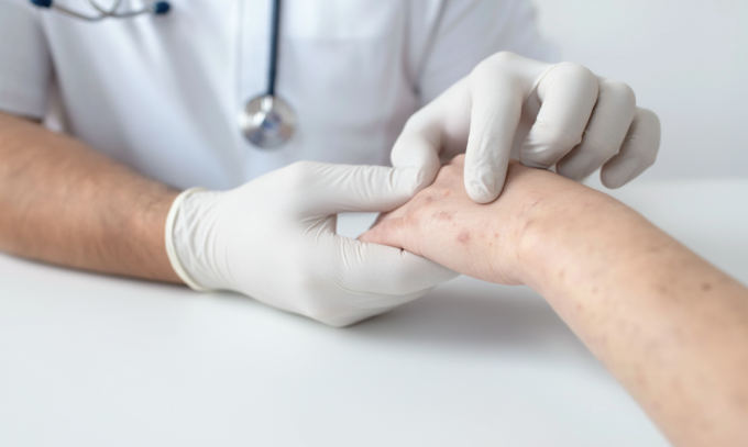 Mụn cóc HPV có thể xuất hiện ở bất kỳ đầu