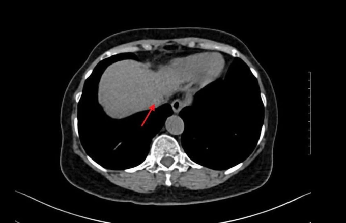 Kết quả chụp MRI ghi nhận bà Bình có u gan. Ảnh: Bệnh viện Đa khoa Tâm Anh