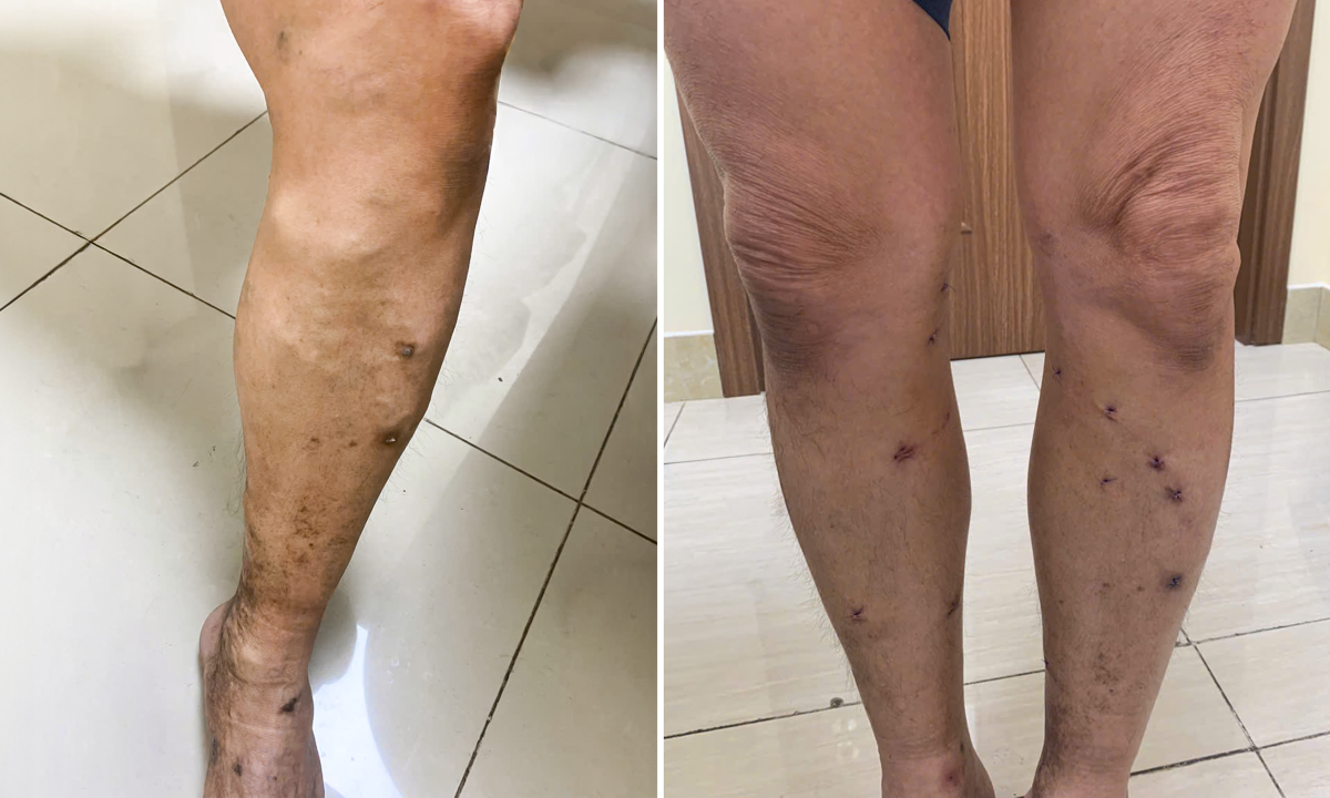 Bơm keo sinh học chữa suy giãn tĩnh mạch