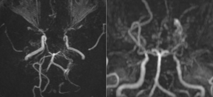 Các mạch máu não của bệnh nhân nhìn như làn khói thuốc lá trên phim chụp MRI. Ảnh: Bệnh viện cung cấp