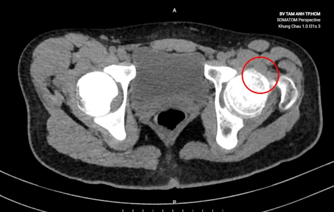 Chụp CT khớp háng bên trái của Phát, trên chỏm xương đùi có mô xương (khoanh tròn) nhô cao lên rõ rệt. Ảnh: Bệnh viện Đa khoa Tâm Anh