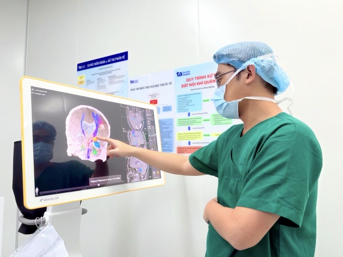 Bác sĩ dựng hình 3D trước mổ để xác định chính xác vị trí ổ động kinh của anh Khang. Ảnh: Bệnh viện Đa khoa Tâm Anh