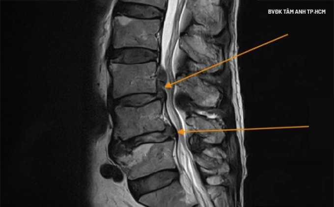 Phim chụp MRI cho thấy vị trí đốt sống thắt lưng bị tổn thương của anh Duy. Ảnh: Bệnh viện Đa khoa Tâm Anh