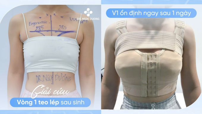 Hình trước - sau thực hiện kỹ thuật nâng ngực tái cấu trúc. Ảnh: Bác sĩ Ngọc Dương