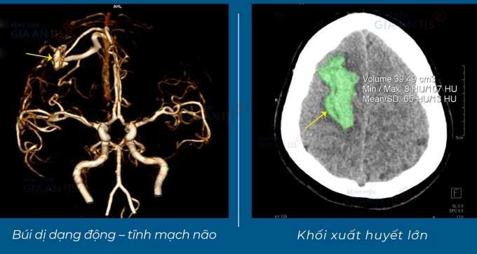 chụp CT sọ não có tiêm thuốc cản quang trên máy CT Somatom Force VB30. Ảnh: Bệnh viện cung cấp