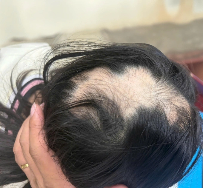 Rụng tóc, hói đầu là nỗi ám ảnh, khiến nhiều nam giới mất tự tin. Ảnh: Nourkrin Hair Growth+ inClinic