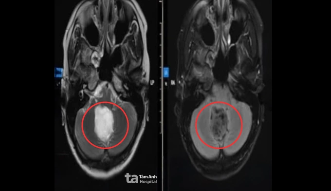 Ảnh chụp MRI u thân não của chị Trang. Ảnh: Bệnh viện Đa khoa Tâm Anh