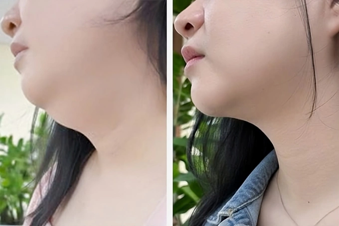 Phần cằm của chị Lan đã săn chắc hơn sau 3 tháng điều trị. Ảnh: Bệnh viện Đa khoa Tâm Anh