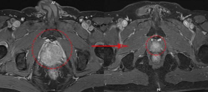 Chụp MRI tuyến tiền liệt của bệnh nhân trước (bên trái) và sau điều trị (bên phải). Ảnh: Bệnh viện Đa khoa Tâm Anh