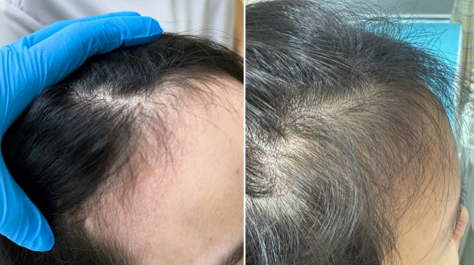 Sau 3 lần điều trị bằng laser 6D, phần tóc của chị Hằng bắt đầu mọc lại. Ảnh: Bệnh viện Đa khoa Tâm Anh