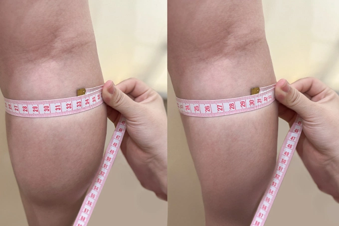 Sau 2 tháng tiêm botox, bắp chân của chị Hồng đã giảm 3 cm. Ảnh: Phòng khám Đa khoa Tâm Anh Quận 7