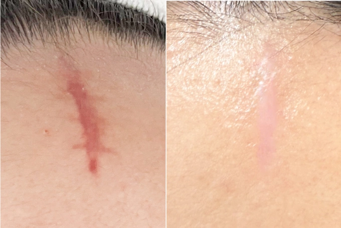 Vết sẹo của chị Phương mờ đi, phẳng hơn sau điều trị. Ảnh: Bệnh viện Đa khoa Tâm Anh
