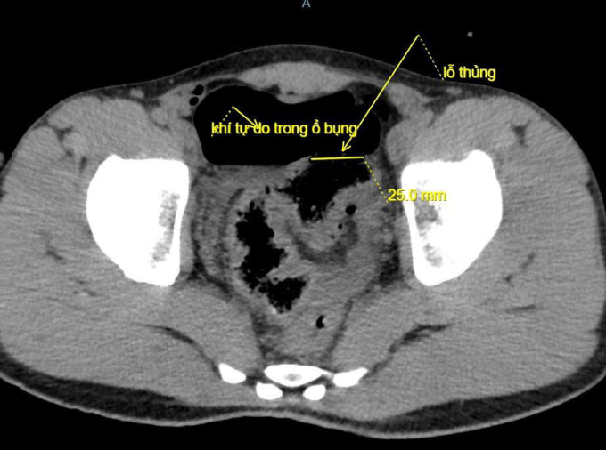 Ảnh chụp CT thủng đại tràng của bệnh nhân. Ảnh: Bệnh viện cung cấp