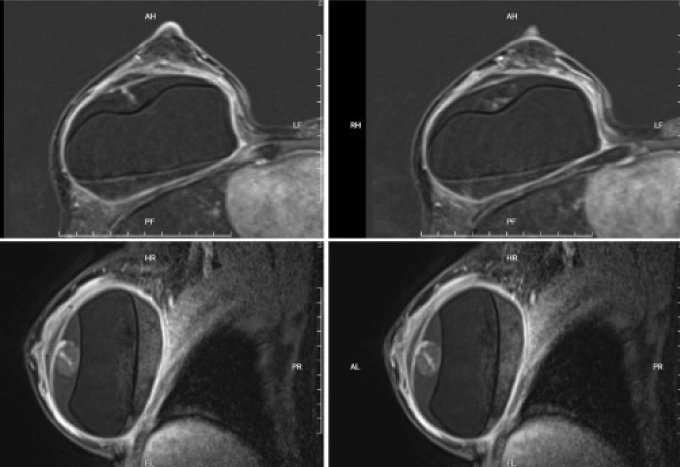 Hình MRI của bà Thắm cho thấy khối máu tụ bên trong ngực của bệnh nhân. Ảnh: Bệnh viện Đa khoa Tâm Anh