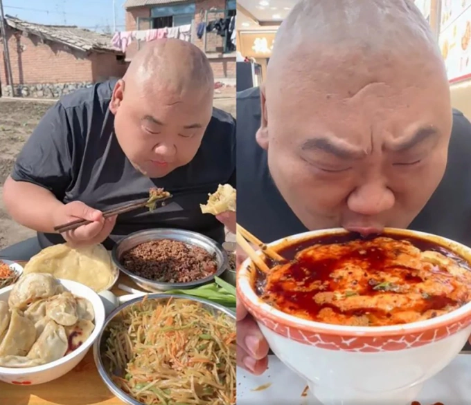 Mặt trái mukbang khiến blogger 175 kg phải cắt 80% dạ dày - 1