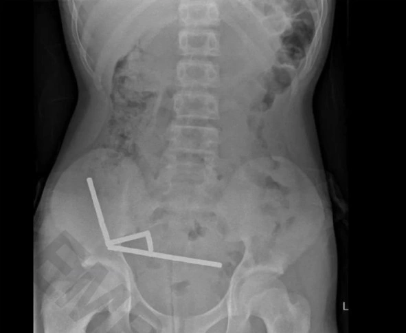 Hình ảnh X quang cho thấy nam châm trong bụng bé trai 13 tuổi. Ảnh: New Zealand Medical Journal