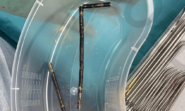 Teen boy has part of intestine removed after swallowing 100 high-powered magnets from Temu