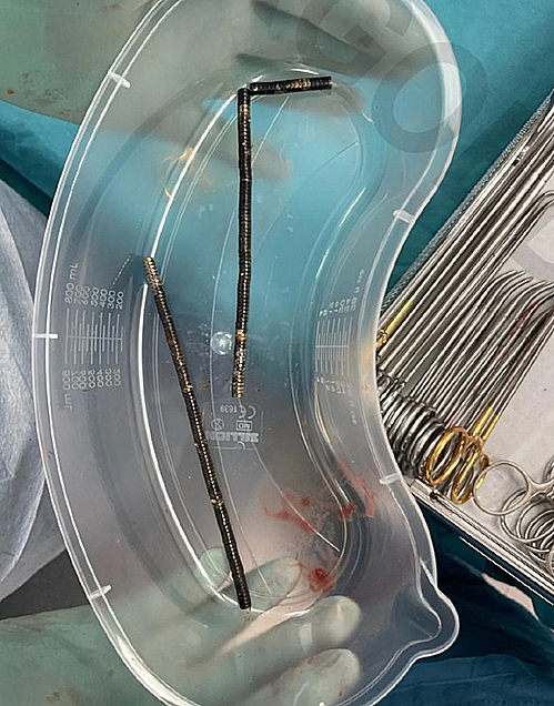 Během operace 13letého pacienta bylo odstraněno asi 80-100 vysoce výkonných magnetů. Foto: New Zealand Medical Journal