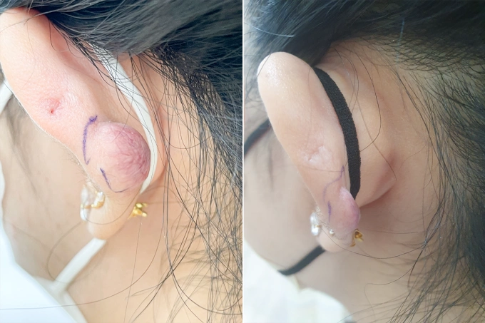 Sẹo lồi như hạt đậu sau xỏ khuyên tai Phần sẹo lồi của chị Thi thu gọn hơn sau 4 lần tiêm hoạt chất triamcinolone. Ảnh: Bệnh viện Đa khoa Tâm Anh