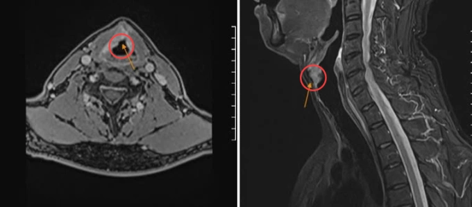 Cắt bán phần dây thanh, bảo tồn giọng nói cho người ung thư Chụp MRI ghi nhận khối u dây thanh phải xâm lấn sụn giáp. Ảnh: Bệnh viện Đa khoa Tâm Anh