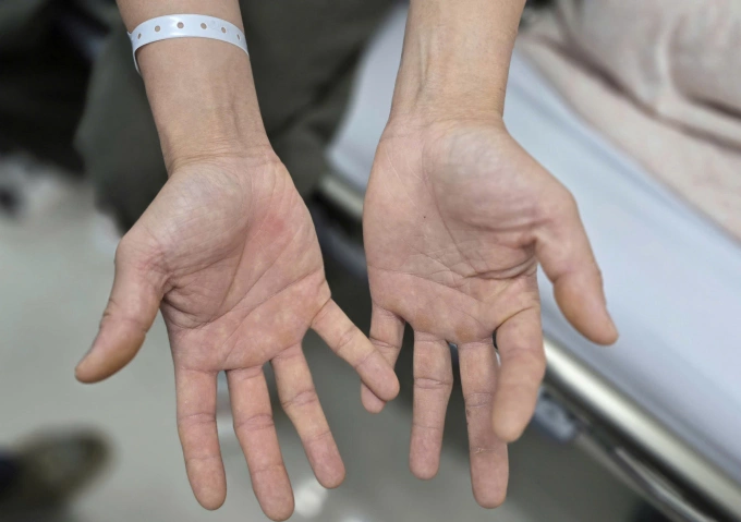 Cuộc sống bên bờ vực của cặp vợ chồng nghiện bóng cười Bàn tay của người chồng bị tê bì, không thể khép lại và mất cảm giác. Ảnh: Mai Thanh