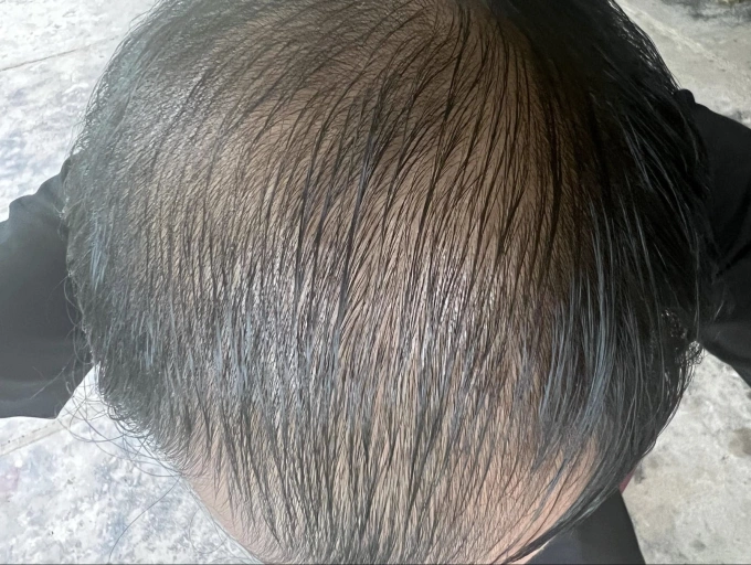 Một người đàn ông bị rụng tóc, vùng đỉnh đầu hói dần. Ảnh: Nhân vật cung cấp