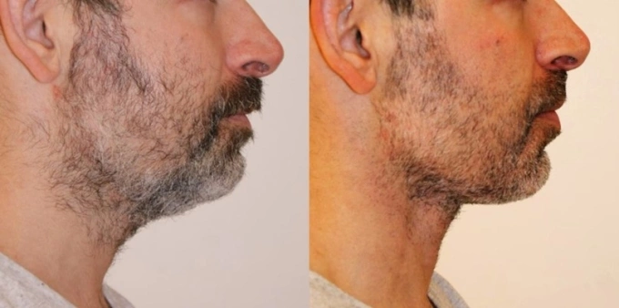 Kỹ sư công nghệ chi trăm nghìn USD căng da vì sợ bị hết thời/Dân công nghệ Thung lũng Silicon đổ xô đi phẫu thuật thẩm mỹ - 1