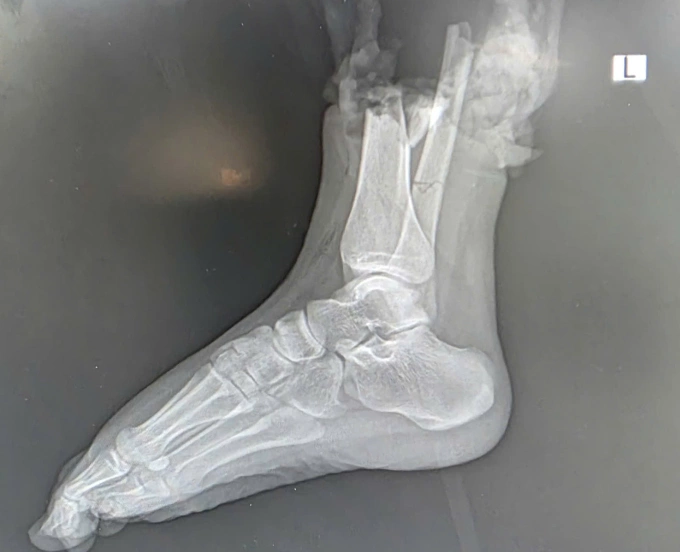 Hình ảnh chụp phần chi thể đứt rời. Ảnh: Bệnh viện cung cấp