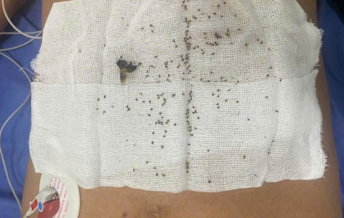 Hơn 300 kim độc được bác sĩ rút ra khỏi cơ thể bệnh nhân. Ảnh: Bệnh viện cung cấp