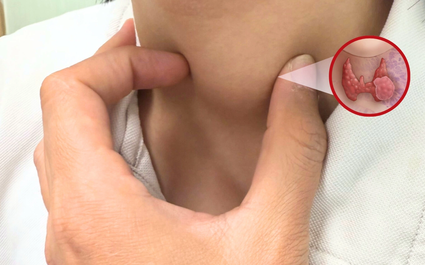 Phẫu thuật thành công ung thư tuyến giáp thể hiếm ở trẻ 13 tuổi - Báo VnExpress Sức khỏe