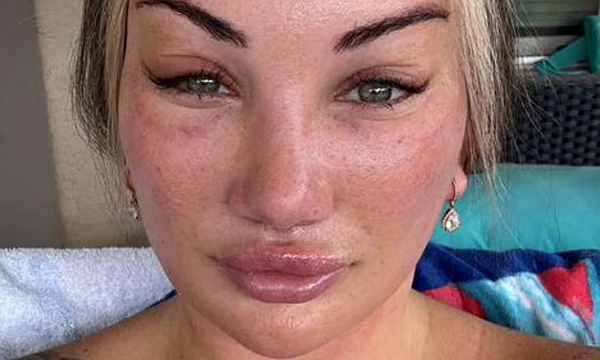 Mặt biến dạng vì filler, cô gái 30 tuổi chi nửa tỷ đồng 'làm lại từ đầu'