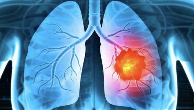 Minh họa khối u ung thư phổi. Ảnh: Johnson & Johnson