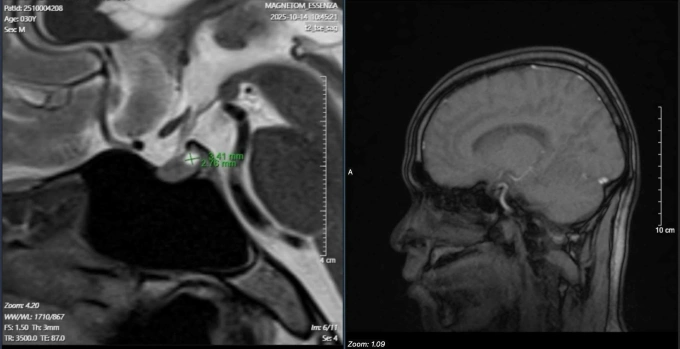 Hình ảnh khối y tuyến yên của bệnh nhân. Ảnh: Bác sĩ cung cấp