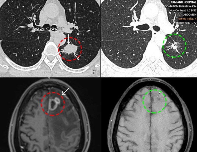 Khối u ở phổi và não của ông Chung trước điều trị (bên trái) và sau điều trị (bên phải). Ảnh: Bệnh viện Đa khoa Tâm Anh